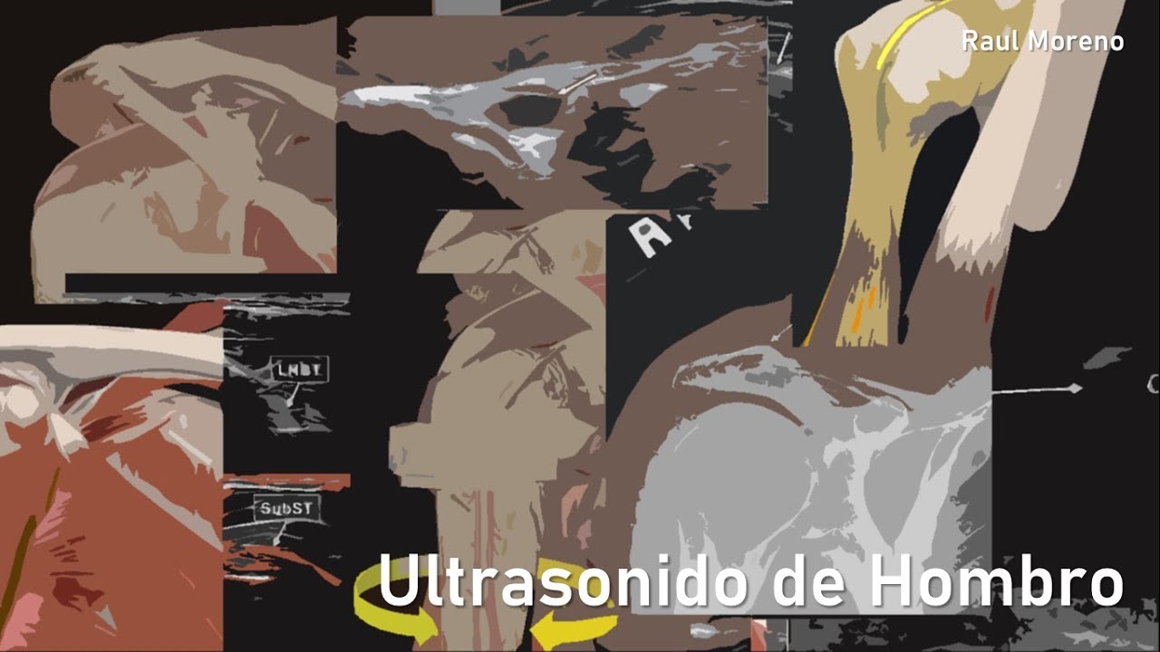 Ultrasonido de Hombro Paso por Paso