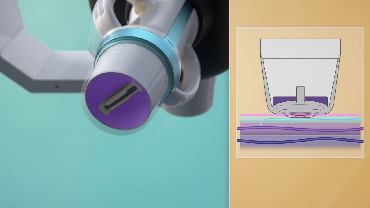 Echotherapy (with SONOVEIN) for the non-invasive treatment of varicose veins