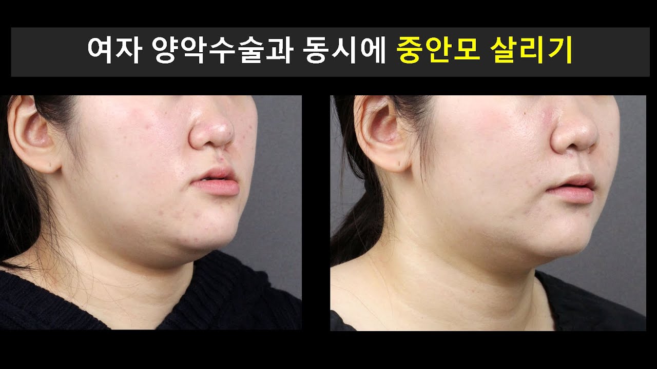 양악수술과 동시에 중안모 증진하기 (Simultaneous Midface Augmentation with Orthognathic Surgery(