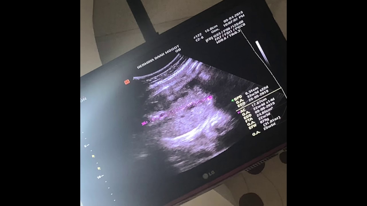 USG Janin 8 bulan