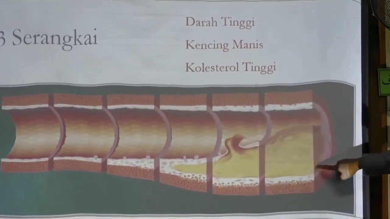 Bahaya salur darah sempit - Dr Safari Elis