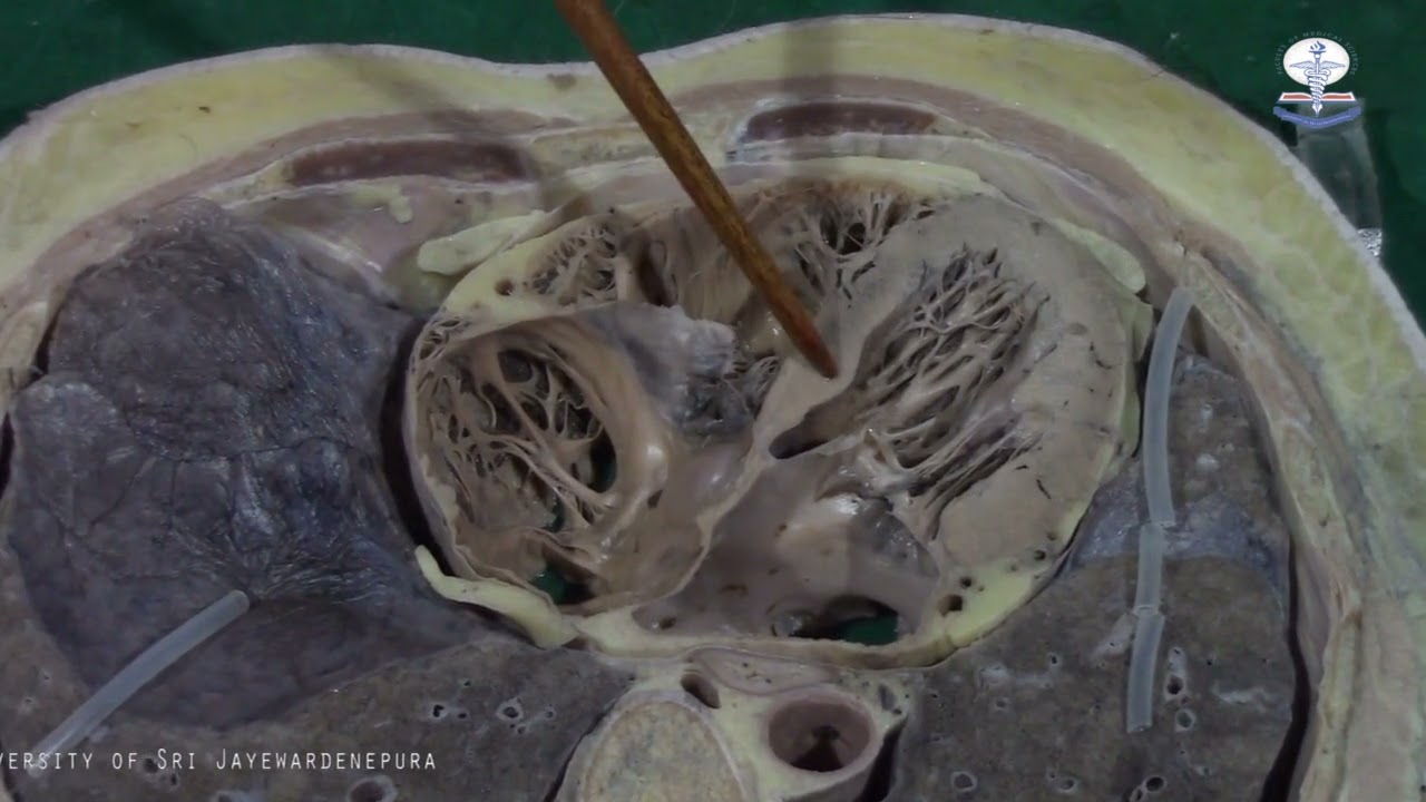 Cadaveric Demonstration Cross section T8 level by Dr Sajith Edirisinghe