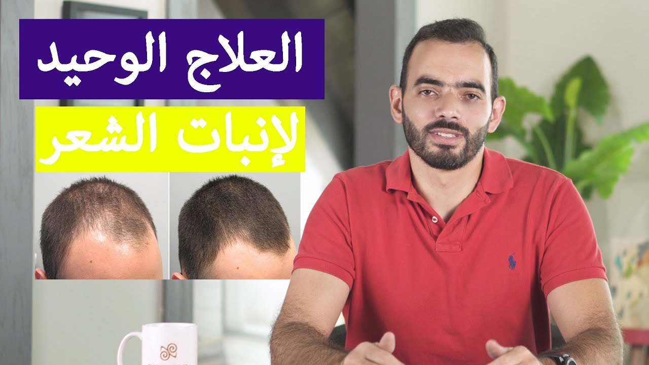 مينوكسيديل - Minoxidil