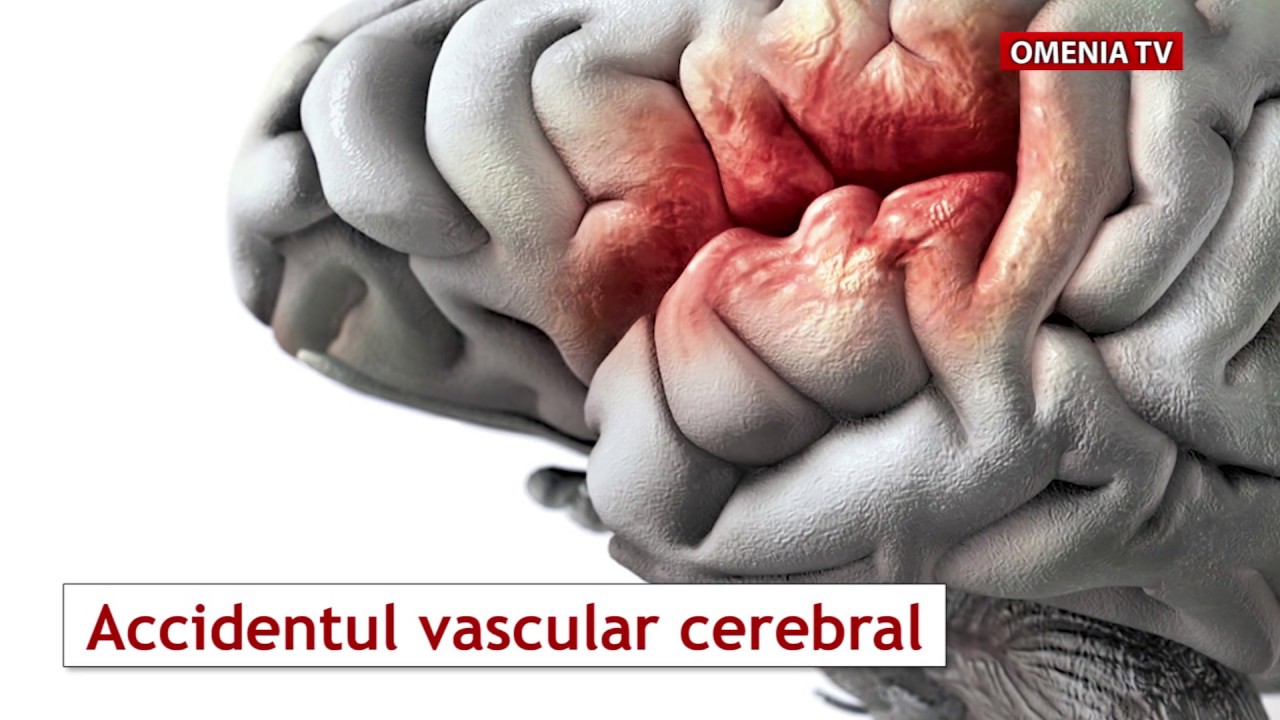 Accidentul vascular cerebral