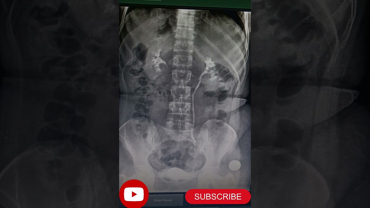 X- RAY PROCEDURE INTRAVENOUS PYLOGRAPHY