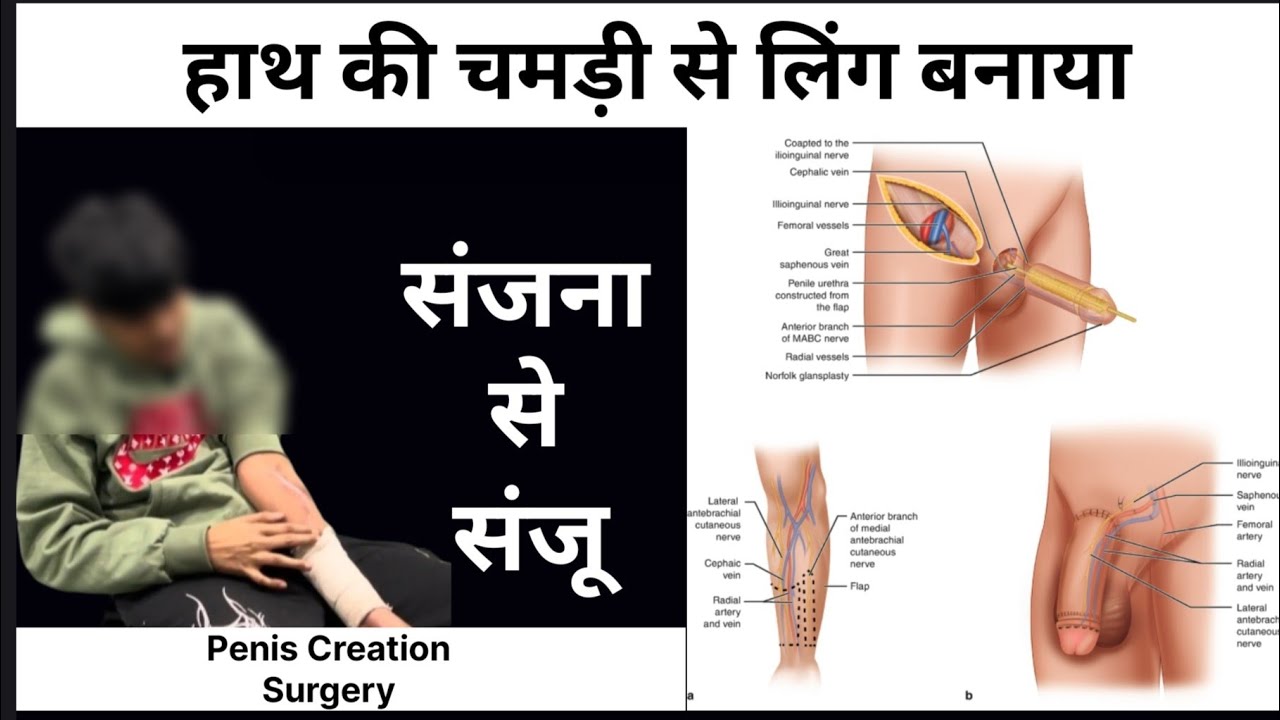हाथ की चमड़ी से लिंग बनाया Female To Male Gender Change Surgery In India Delhi Mumbai Bangalore Goa