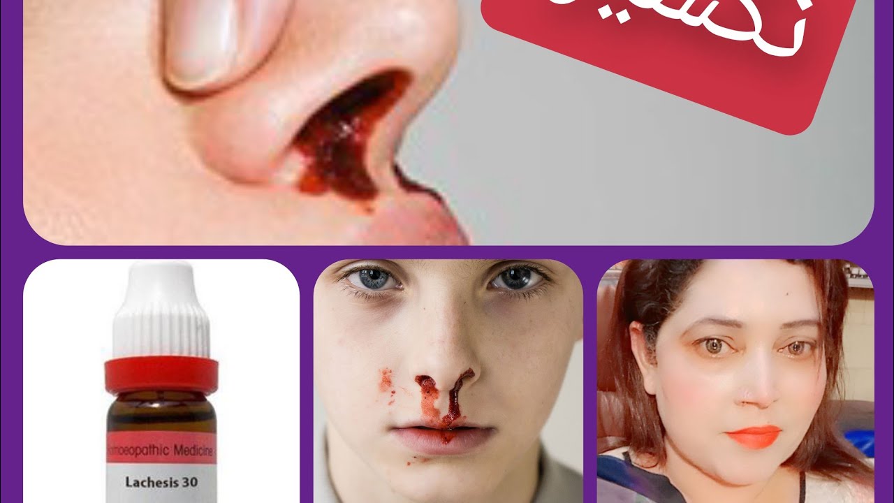 Epistexis#nose bleeding#نکسیر # کنکسیر  کی مختلف اقسام اور ہومیوپیتھک میں علاج