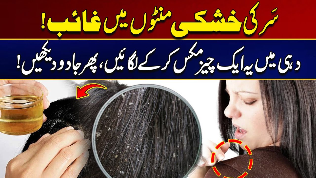 Natural Dandruff Removal Hack | Watch This Video | City  41