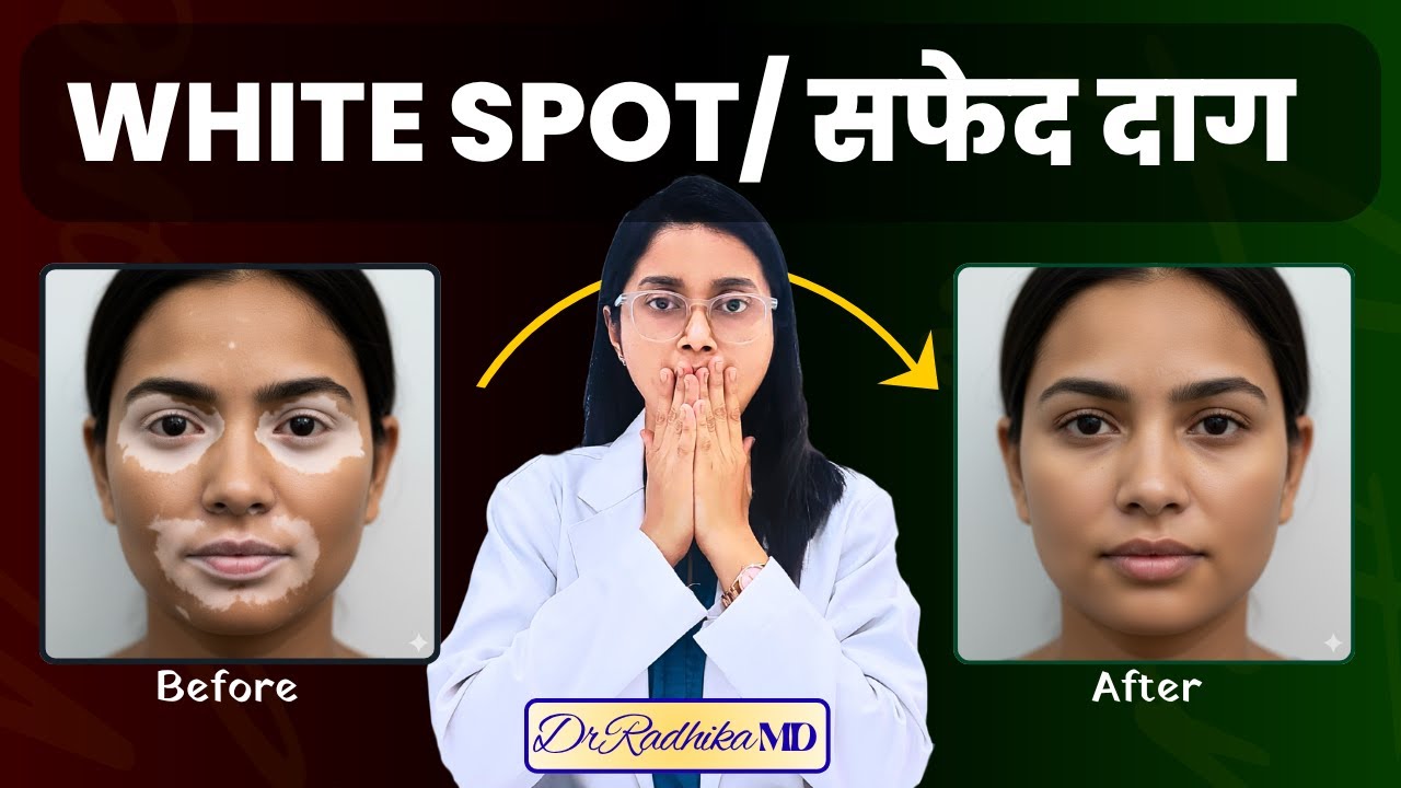 White Spot का सच! Vitiligo होने से पहले ये Signs दिखते हैं | Truth Nobody Tells #whitespots