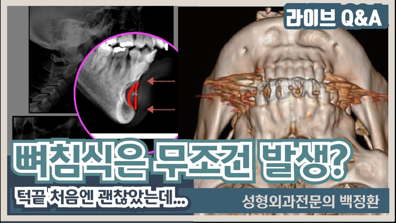뼈침식은 무조건 발생할까요?