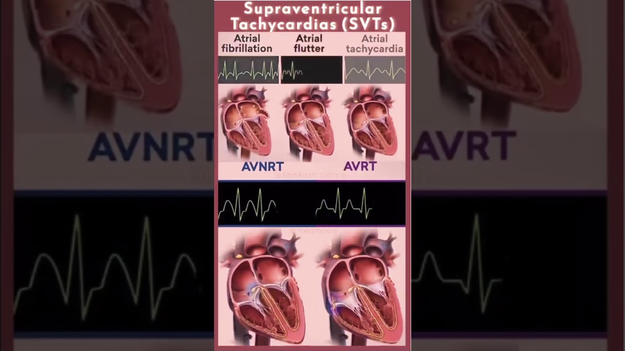 Aritmiile supraventriculare AVNRT, AVRT, Tahicardia atriala