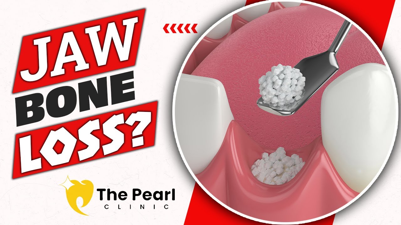 Jaw Bone Weak? See How Bone Grafting Can Fix It Fast!