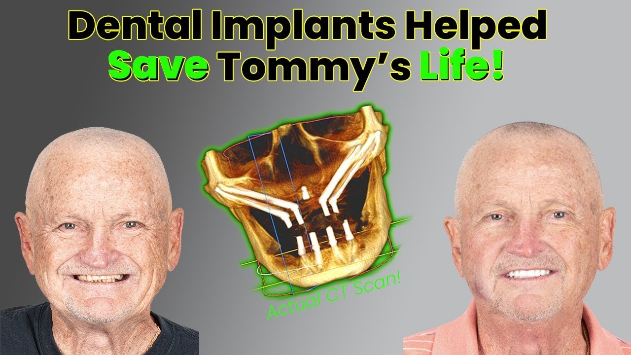 How All on 4 Dental Implants Helped Save This Cancer Survivor's Life!