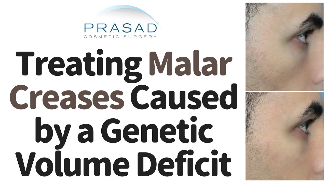 How Malar Creases Caused by a Genetic Volume Deficit can be Treated