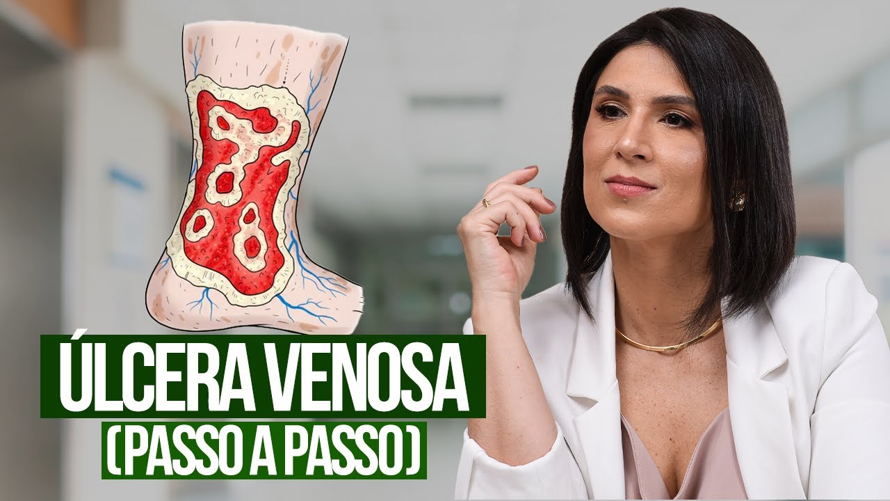 Como Cicatrizar uma Úlcera Venosa