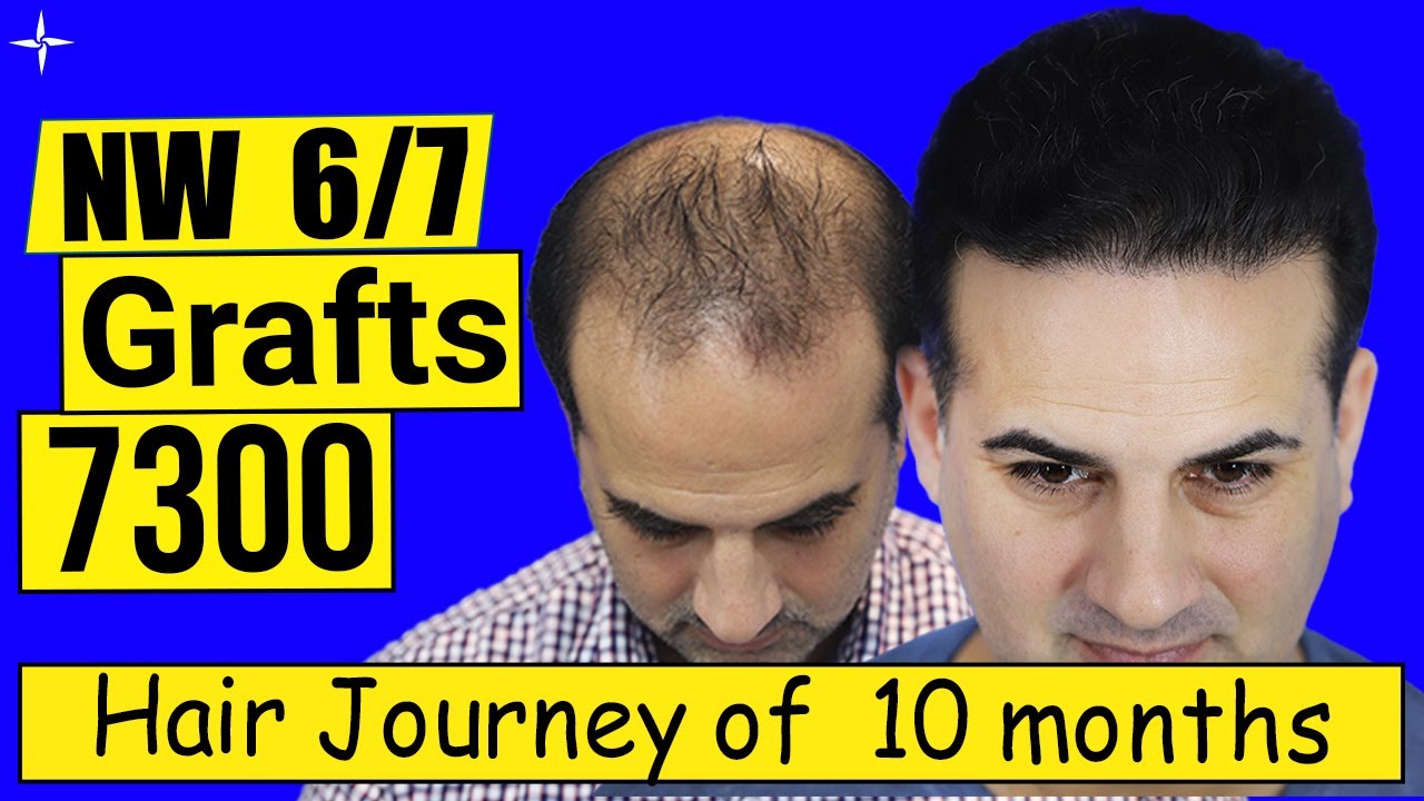 Hair Transplant Result in 10 Months, 7300 Grafts, Grade 6/7, @ Eugenix by Expert Hair Surgeons
