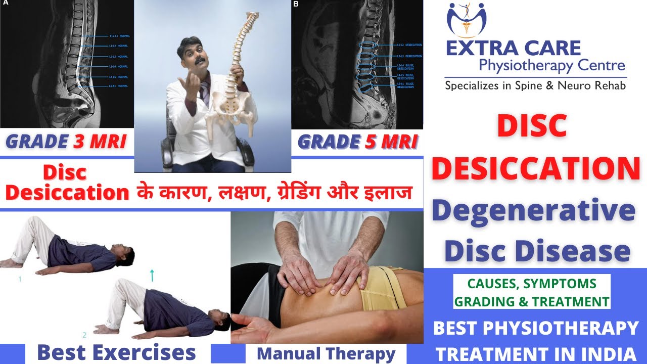 DISC DESICCATION in SPINE | Degenerative Disc Disease | Causes, Symptoms, Grading & TREATMENT
