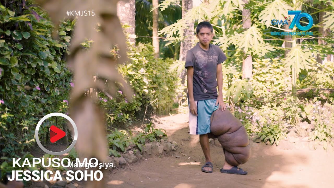 Kapuso Mo, Jessica Soho: Kaliwang binti ng 24-anyos mula   Quezon, bakit patuloy na lumolobo?