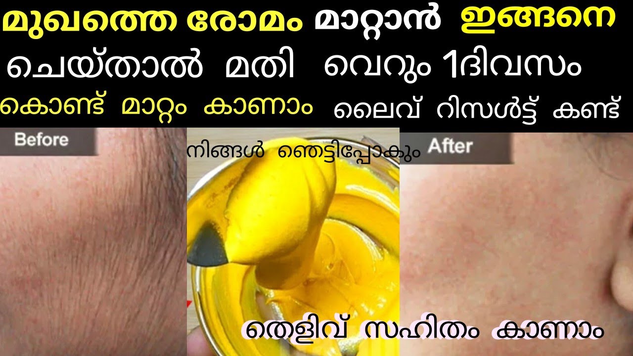 Facial hair കളയാൻ എളുപ്പവഴി|hair removing natural homemade remedy|ലൈവ് റിസൾട്ട് കണ്ട് നിങ്ങൾ ഞെട്ടും