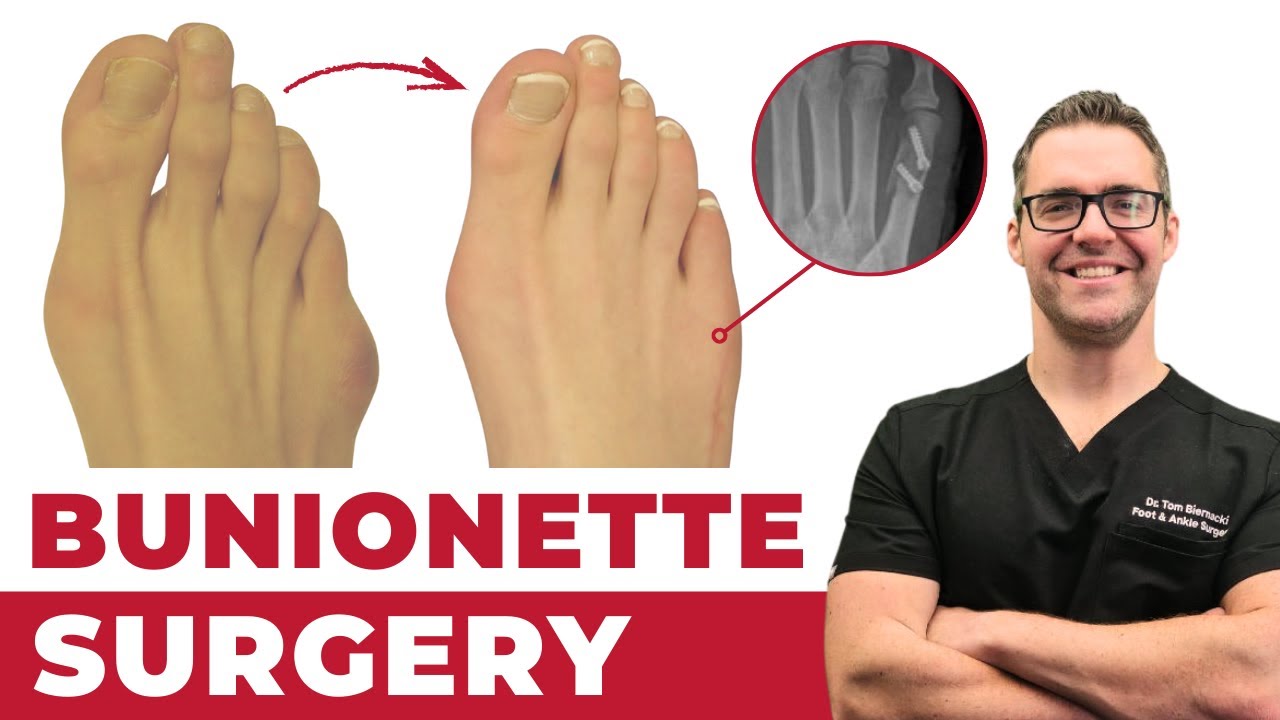 Bunionette Tailor's Bunion Surgery? [Corrector, Splints & Treatment]