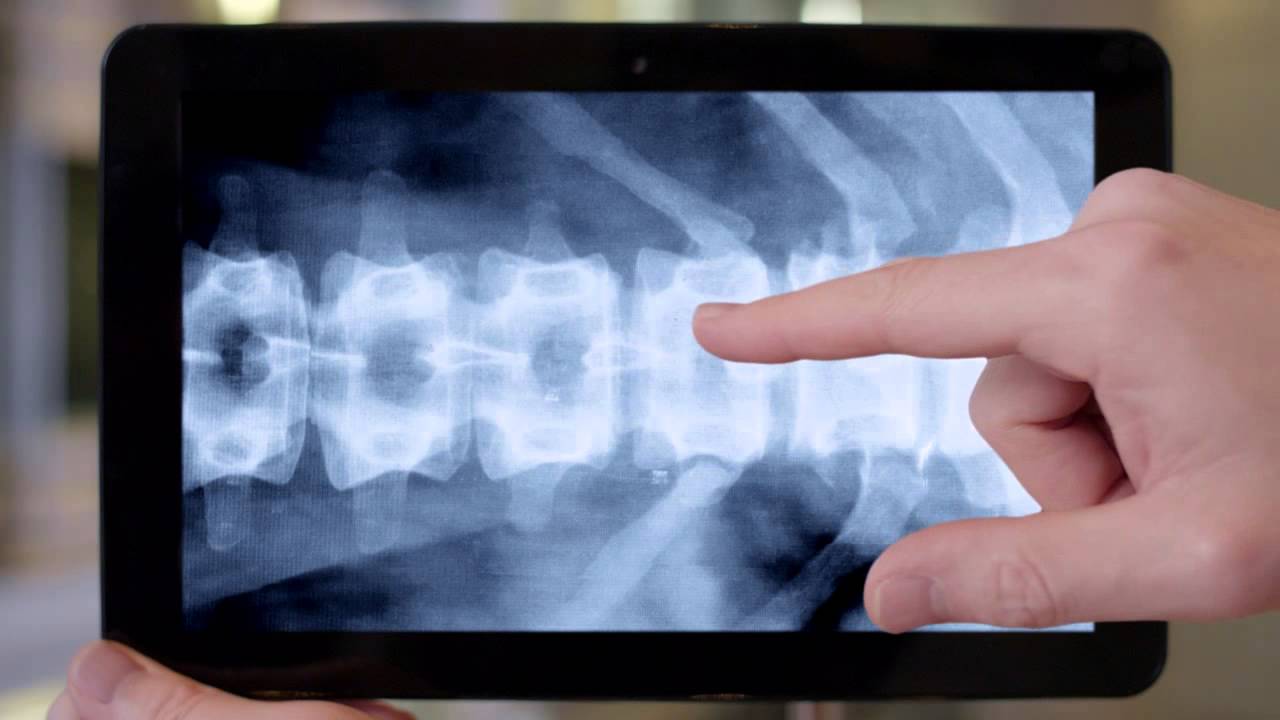 TV Ad: Comprehensive Spine Care Video - Brigham and Women's Hospital