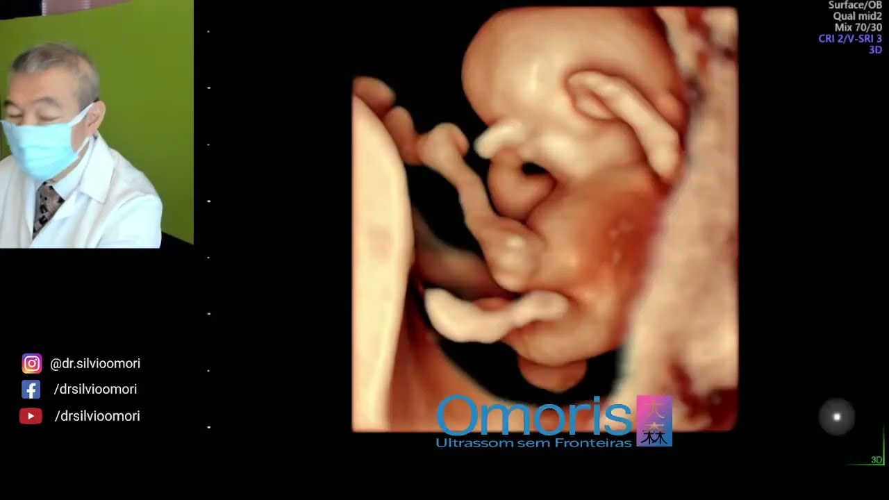 Ultrassom 10 semanas