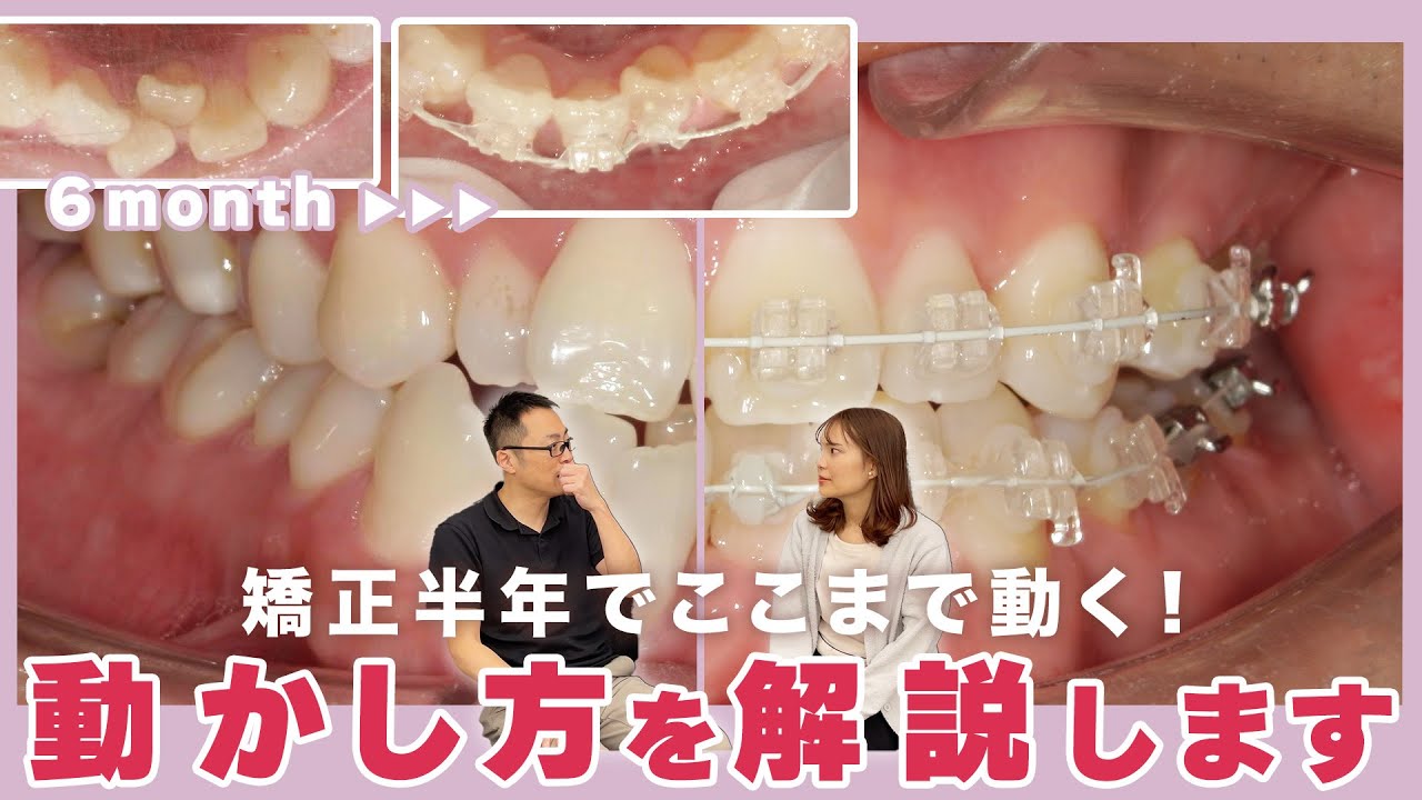 【矯正半年経過】どこがどう動いた？どこが注意点？解説します【クリスタルブラケット】