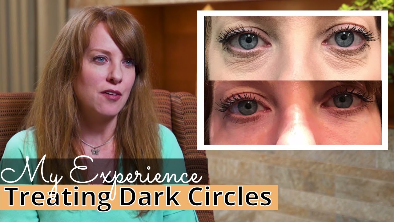 Dark Circles Under the Eyes [My Experience] #Microneedling with #PRP for #EyeBags
