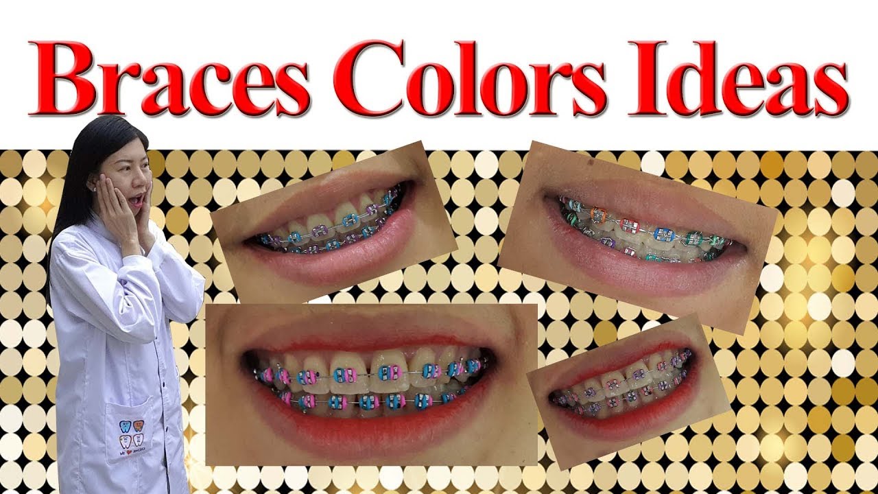 Braces Colours Ideas!
