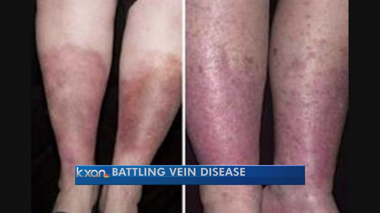 New vein disease treatment arrives in Austin