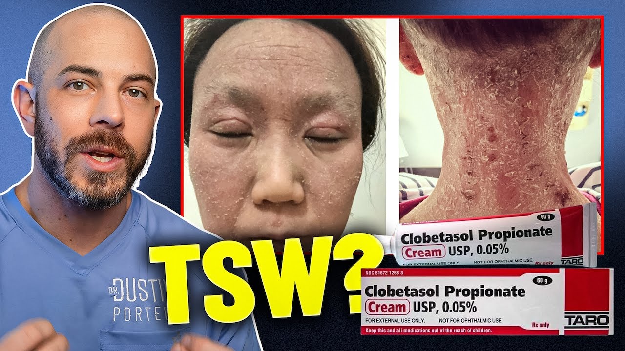 Is Topical Steroid Withdrawal Real? Dermatologist Answers TSW
