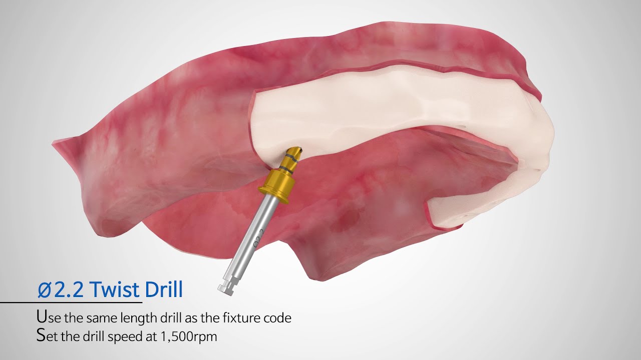 [SEWONMEDIX] Multi-Unit Abutment Process