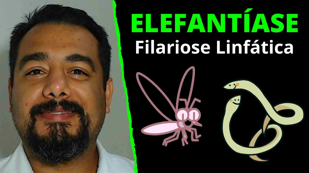 Elefant&iacute;ase (Filariose Linf&aacute;tica) | Wuchereria bancrofti (Fil&aacute;ria) | Curso de Parasitologia Humana