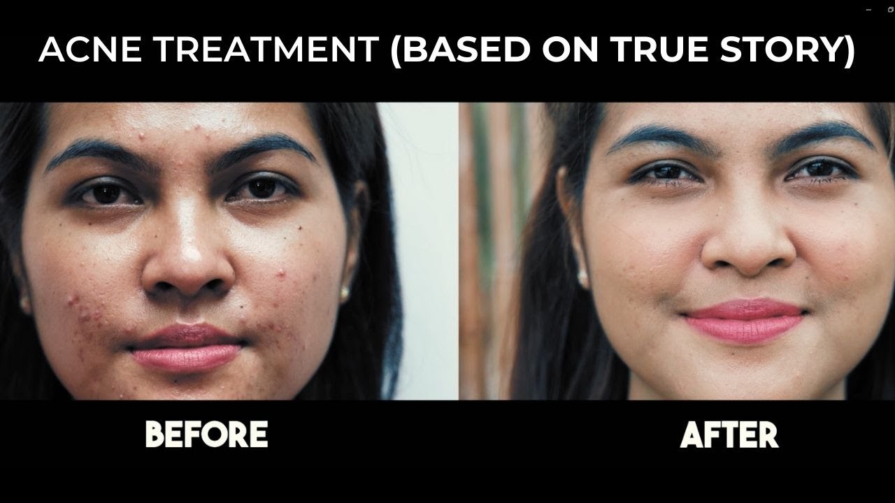 Acne Treatment Journey With  Dr Ko Skin Specialist (Drama Based on True Story)