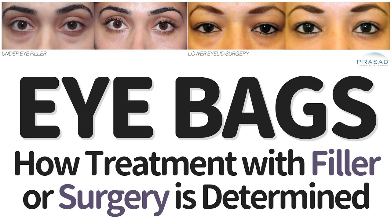 How Treating Eye Bags with Filler or Surgery is Determined