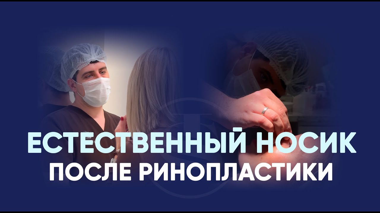 Натуральный нос без лишних акцентов: открытая риносептопластика