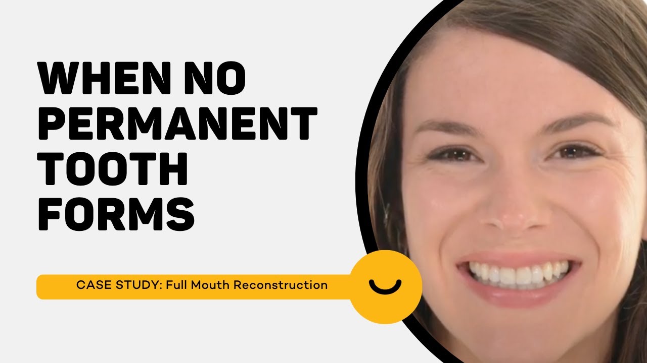 Congenitally Missing Front Teeth - Before and After