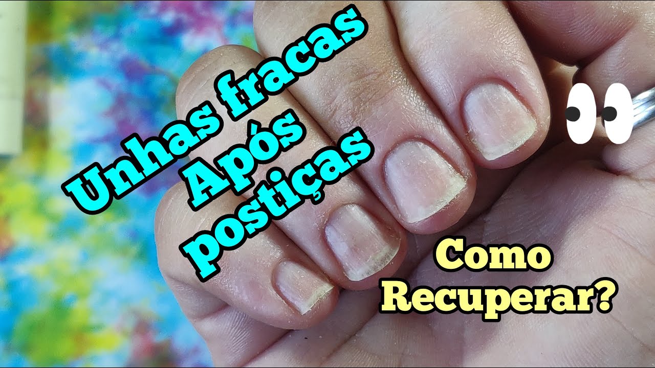 UNHAS DETONADAS POR CAUSA DAS POSTIÇAS. COMO RECUPERAR?