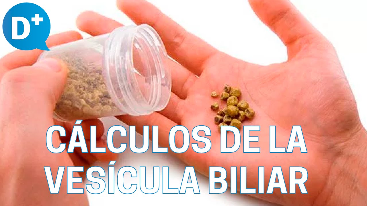 Causas y s&iacute;ntomas de los c&aacute;lculos de la ves&iacute;cula biliar