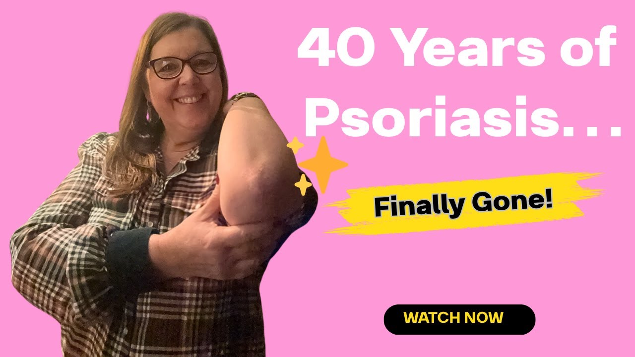 After 40 Years with Psoriasis… I Finally Found What Cleared My Skin!
