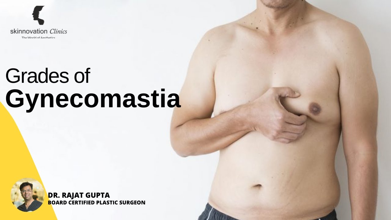 3 Gynecomastia Grades & How to Treat Them? Gynecomastia Ka ilaj | Male Breast | Dr Rajat Gupta