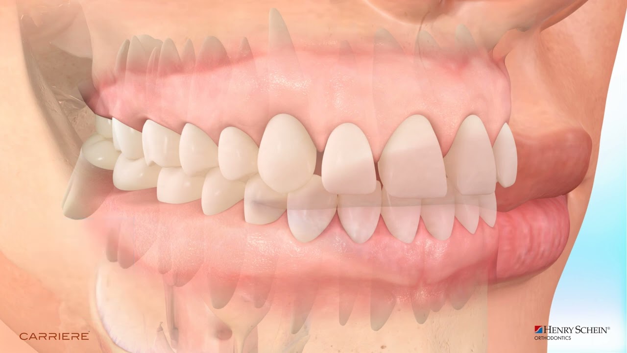 Carriere Motion Appliance with Braces