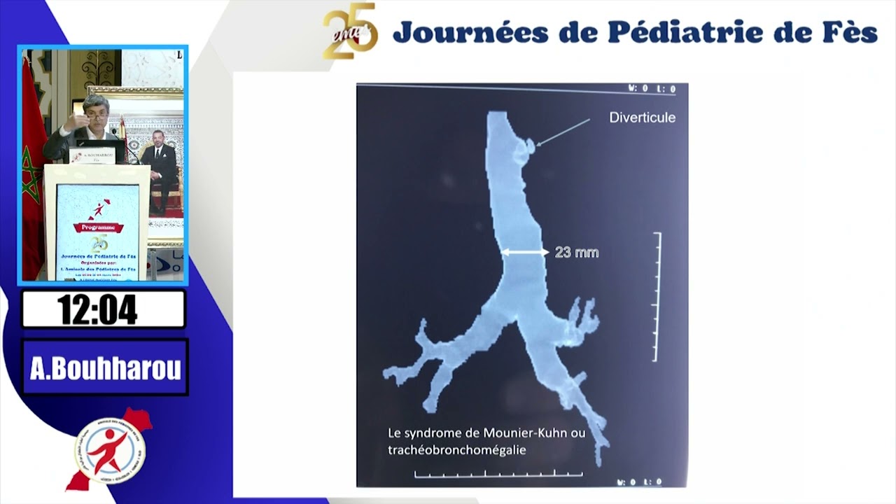 Une toux pas comme les autres: A. Bouharrou