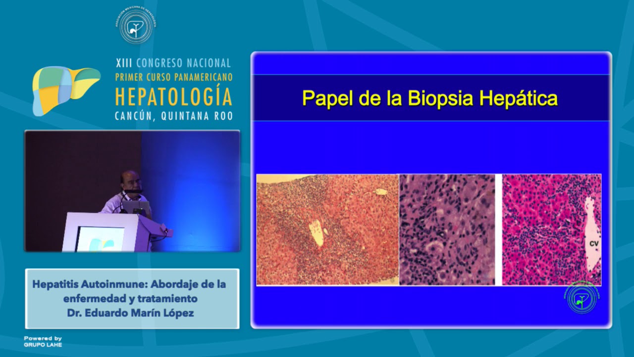 Taller B - Hepatitis Autoinmune: Abordaje de la enfermedad y tratamiento