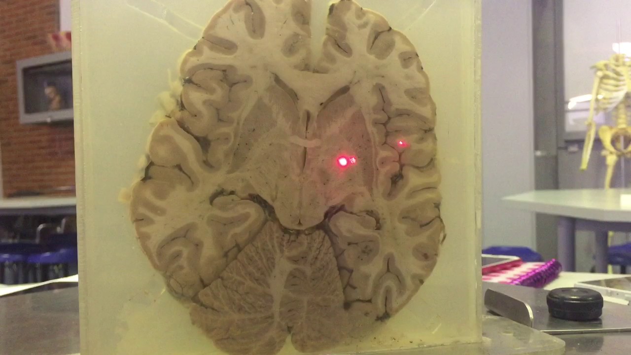 Corte Axial del encéfalo . Cerebro real parte 2