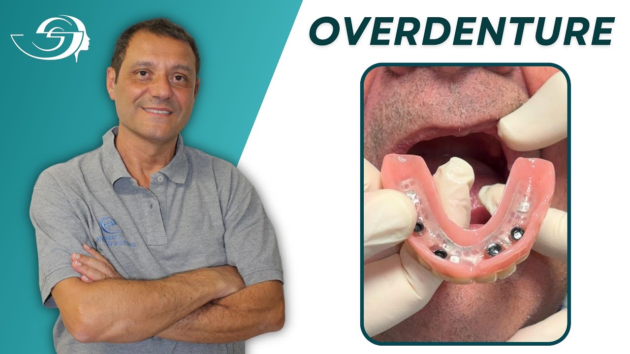 Protesi Dentali Rimovibili OVERDENTURE - Caso Clinico