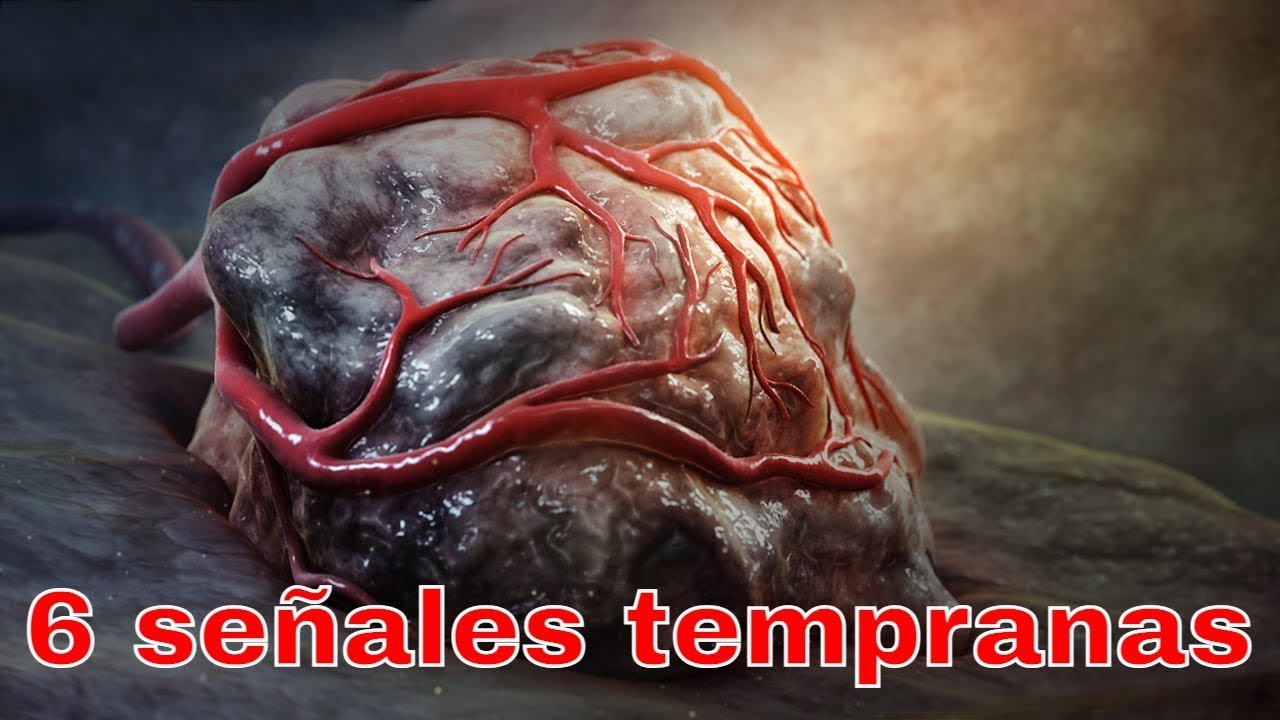 6 señales de que tendrás cáncer de estómago