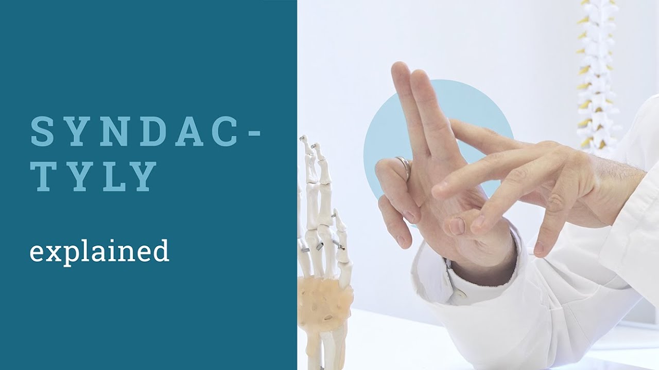 Syndactyly | Dr. Sebastian Farr explains