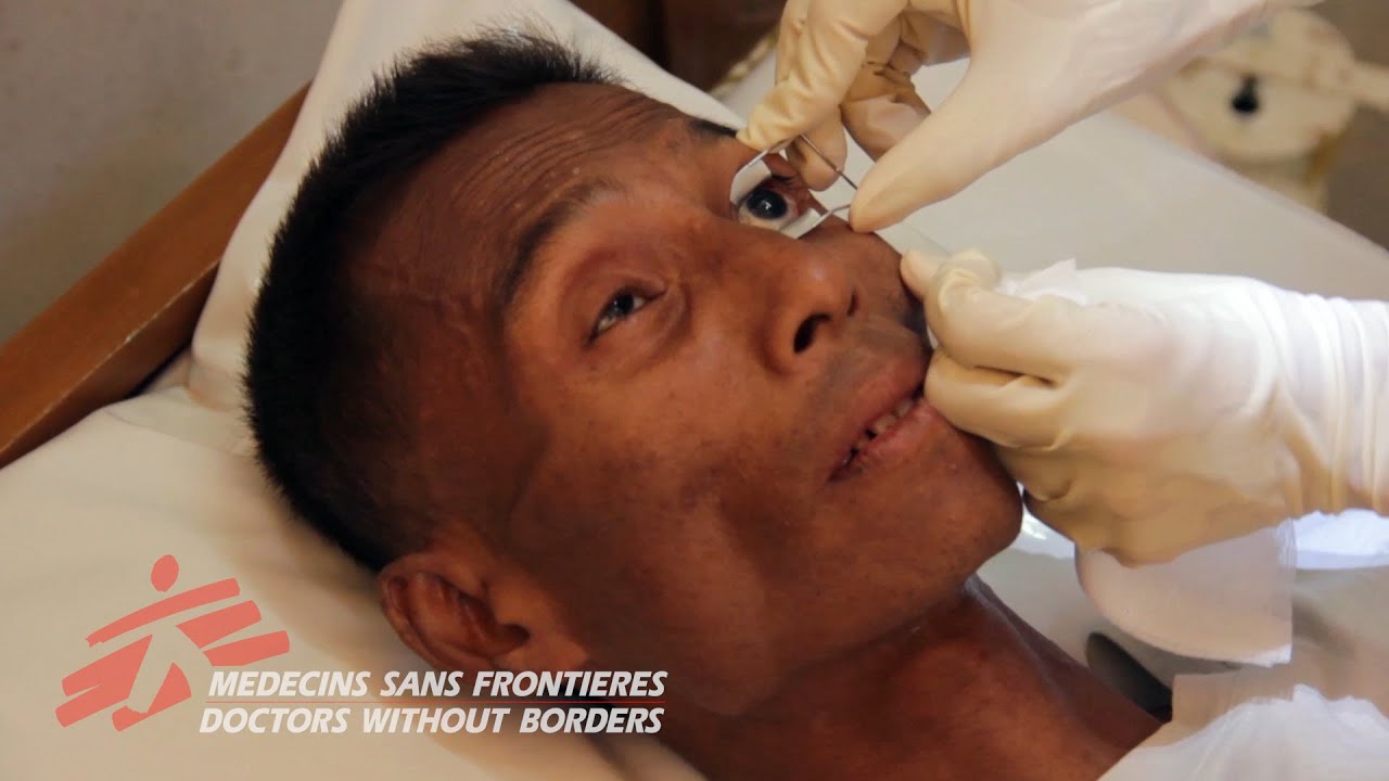Myanmar - HIV-Related Blindness