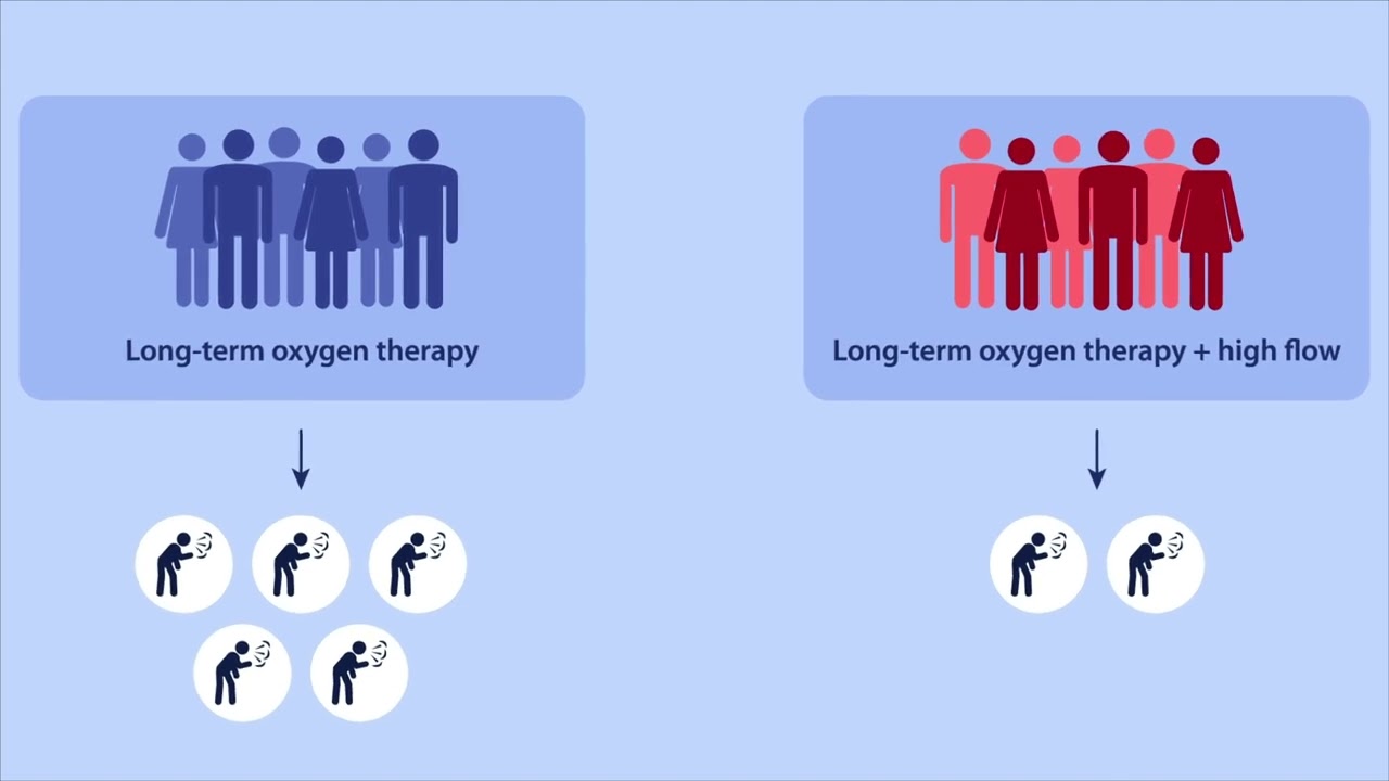 High-flow nasal cannula oxygen therapy: An effective treatment option for COPD